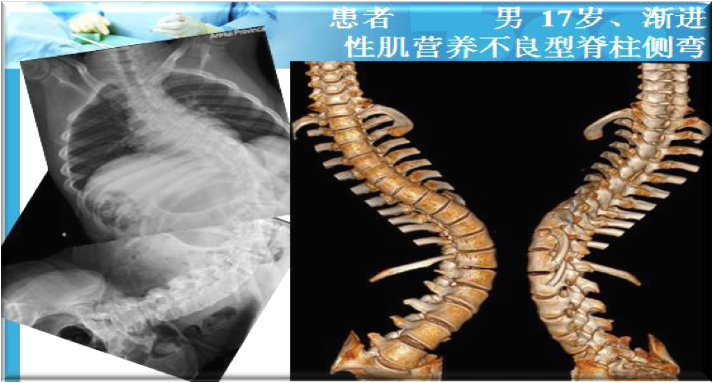 上海數(shù)造攜手安徽省二院骨三科專家章玉冰主任 開展3D打印醫(yī)療骨科應(yīng)用在線講堂